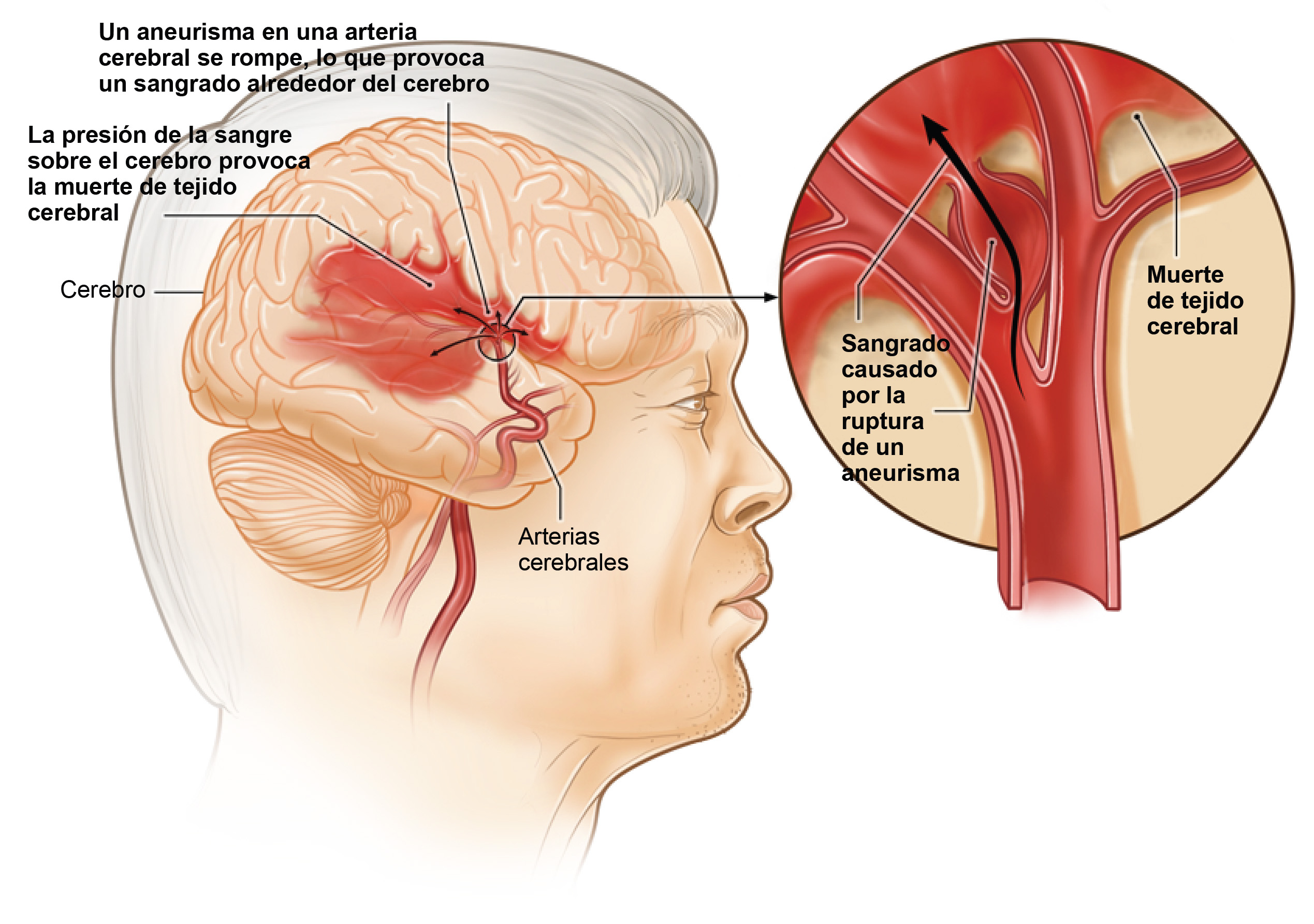 Accidente Cerebrovascular Causas Y Factores De Riesgo Nhlbi Nih